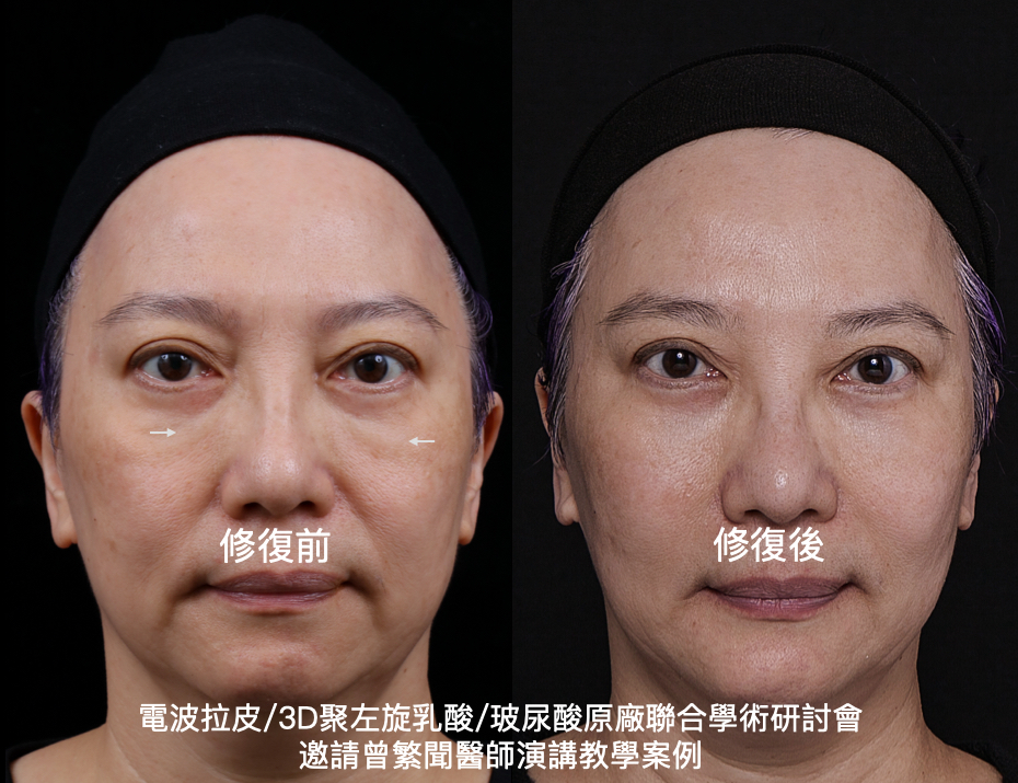 淚溝 tear trough 毛毛蟲 玻尿酸 hyaluronic acid filler 副作用 complication 失敗 不自然 微整型 微整形 修復 恢復 熊貓針 淚溝針 眼袋針 黑眼圈 藍光反應 廷得爾效應