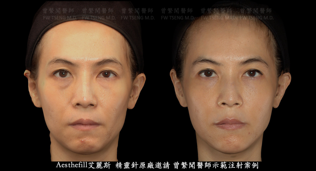 蘋果肌 cheek 豐頰 臉頰凹陷 淚溝 tear trough 眼袋 eye bag 黑眼圈 dark circle 熊貓針 法令紋 鼻唇溝 笑紋 nasolabial fold 木偶紋 marionette line 嘴邊肉 jowl 豐唇 lip 膚質改善 
曾繁聞醫師 擔任 精靈針 艾麗斯 聚雙旋乳酸 Aesthefill國際講師 示範注射教學案例 
微整形 微整型 玻尿酸 台灣 台北 桃園 ptt 推薦 技術 效果 
hyaluronic acid filler injection Taipei Taiwan 