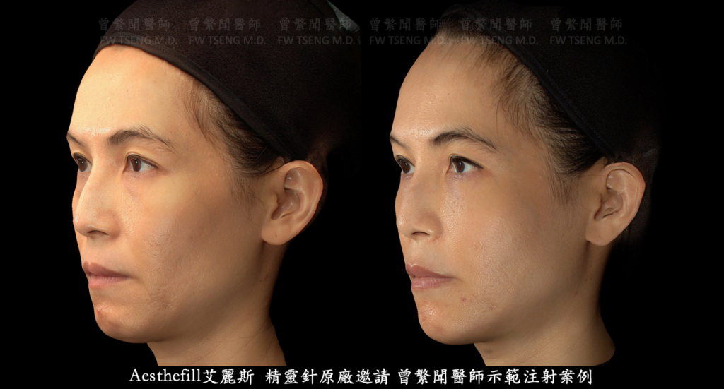 蘋果肌 cheek 豐頰 臉頰凹陷 淚溝 tear trough 眼袋 eye bag 黑眼圈 dark circle 熊貓針 法令紋 鼻唇溝 笑紋 nasolabial fold 木偶紋 marionette line 嘴邊肉 jowl 豐唇 lip 膚質改善 
曾繁聞醫師 擔任 精靈針 艾麗斯 聚雙旋乳酸 Aesthefill國際講師 示範注射教學案例 
微整形 微整型 玻尿酸 台灣 台北 桃園 ptt 推薦 技術 效果 
hyaluronic acid filler injection Taipei Taiwan 