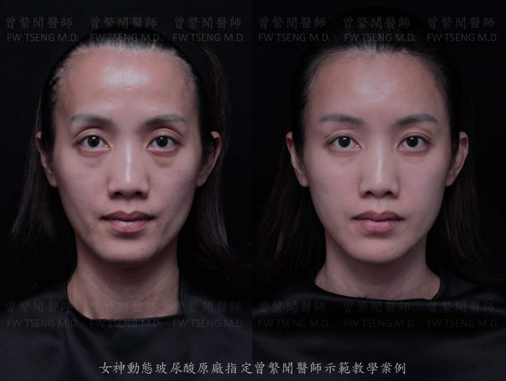 額頭 forehead 太陽穴凹陷 夫妻宮 temple 上眼窩凹陷 sunken upper eyelid 提眉 brow lift 蘋果肌 cheek 淚溝 tear trough 眼袋 eye bag 黑眼圈 dark circle 熊貓針 印地安紋 貓咪紋 嘴邊肉 jowl 豐頰 臉頰凹陷 拉提 lift 
曾繁聞醫師 擔任 瑞絲朗 女神動態玻尿酸 Restylane OBT 全球顧問與國際級講師 示範注射教學案例 
微整形 微整型 玻尿酸 台灣 台北 桃園 ptt 推薦 技術 效果 
hyaluronic acid filler injection Taipei Taiwan 