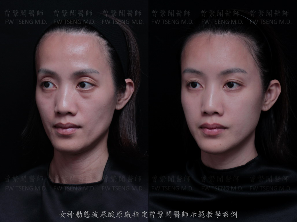 額頭 forehead 太陽穴凹陷 夫妻宮 temple 上眼窩凹陷 sunken upper eyelid 提眉 brow lift 蘋果肌 cheek 淚溝 tear trough 眼袋 eye bag 黑眼圈 dark circle 熊貓針 印地安紋 貓咪紋 嘴邊肉 jowl 豐頰 臉頰凹陷 拉提 lift 
曾繁聞醫師 擔任 瑞絲朗 女神動態玻尿酸 Restylane OBT 全球顧問與國際級講師 示範注射教學案例 
微整形 微整型 玻尿酸 台灣 台北 桃園 ptt 推薦 技術 效果 
hyaluronic acid filler injection Taipei Taiwan 