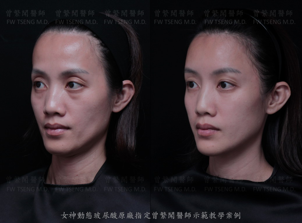 額頭 forehead 太陽穴凹陷 夫妻宮 temple 上眼窩凹陷 sunken upper eyelid 提眉 brow lift 蘋果肌 cheek 淚溝 tear trough 眼袋 eye bag 黑眼圈 dark circle 熊貓針 印地安紋 貓咪紋 嘴邊肉 jowl 豐頰 臉頰凹陷 拉提 lift 
曾繁聞醫師 擔任 瑞絲朗 女神動態玻尿酸 Restylane OBT 全球顧問與國際級講師 示範注射教學案例 
微整形 微整型 玻尿酸 台灣 台北 桃園 ptt 推薦 技術 效果 
hyaluronic acid filler injection Taipei Taiwan 